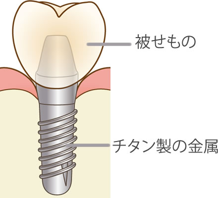 インプラントの説明